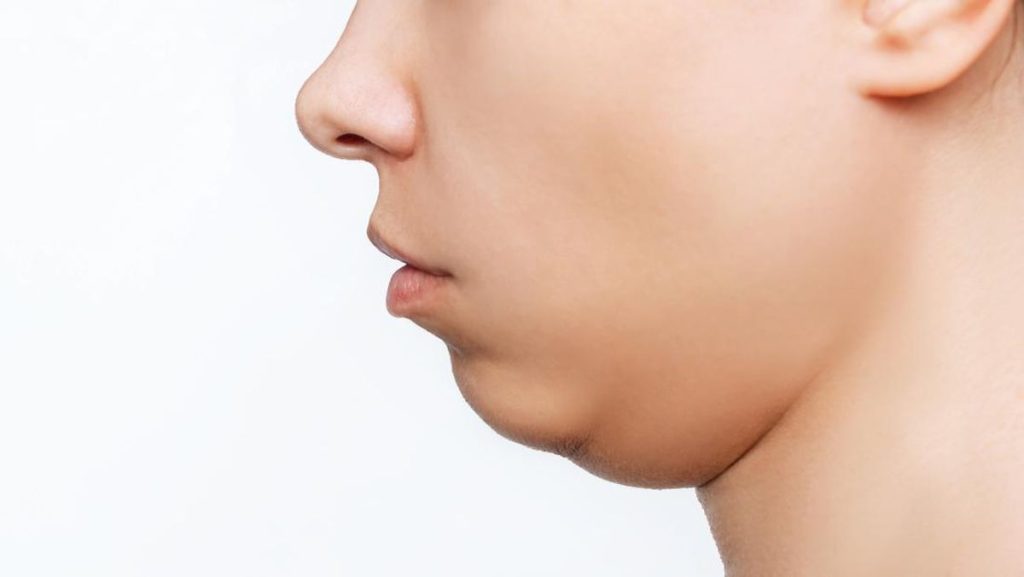 Double Chin