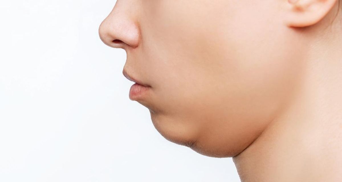 Double Chin Bikin Sebal Karena Mengganggu Penampilan