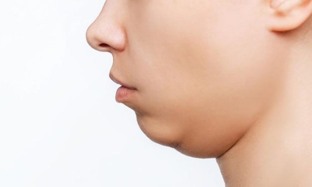 Double Chin Bikin Sebal Karena Mengganggu Penampilan